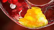 Cholesterin-Mythen entlarvt: Ernährung spielt geringere Rolle als angenommen