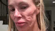 Real-Housewives-Star: Geplatzte Brustimplantate statt Parasiten verursachten Gesichtsdeformationen