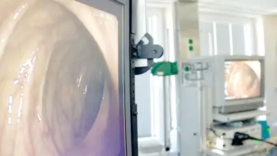 Darmkrebs-Früherkennung: Gleichstellung ab 50 für Frauen beschlossen