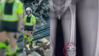 Penis-Gate auf Röntgenbild: Bauarbeiter übersieht pikantes Detail