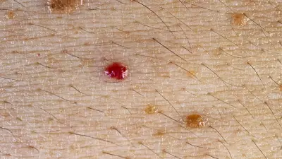 Rubinflecken: Harmlose rote Punkte auf der Haut