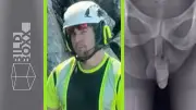 Peinlicher Video-Patzer: Röntgenbild zeigt mehr als nur das Knie