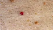 Rubinflecken: Harmlose rote Punkte auf der Haut