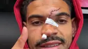 Stirn aufgerissen: Gibbs-White zeigt üble Narbe nach Zusammenprall