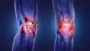 Hyaluron-Injektionen bei Arthrose: Was Patienten wissen müssen