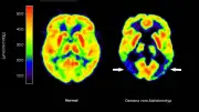 Neue Studie: Arthrose-Mittel Glucosamin als Demenz-Treiber entlarvt