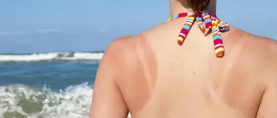 Dermatologin über Botox, Sonnenbrand und Melkfett: „Sind Sie ein entzündeter Euter oder ein Mensch?“