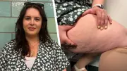 Lipödem-Diagnose nach Jahren: Julias Geschichte und Warnsignale