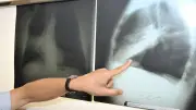 Lungenkrebs-Screening für Raucher: So kommen Sie an einen Termin